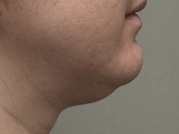 Neck & Chin Liposuction