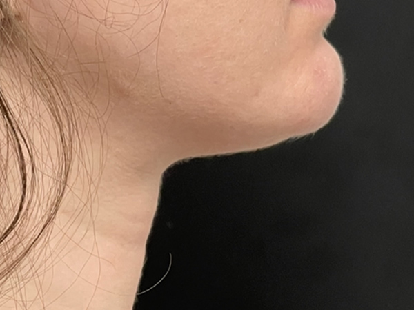Neck & Chin Liposuction