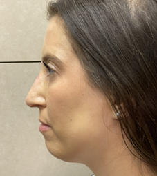 Rhinoplasty