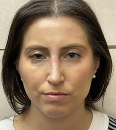 Rhinoplasty