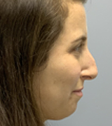 Rhinoplasty