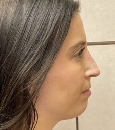 Rhinoplasty