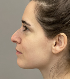 Rhinoplasty