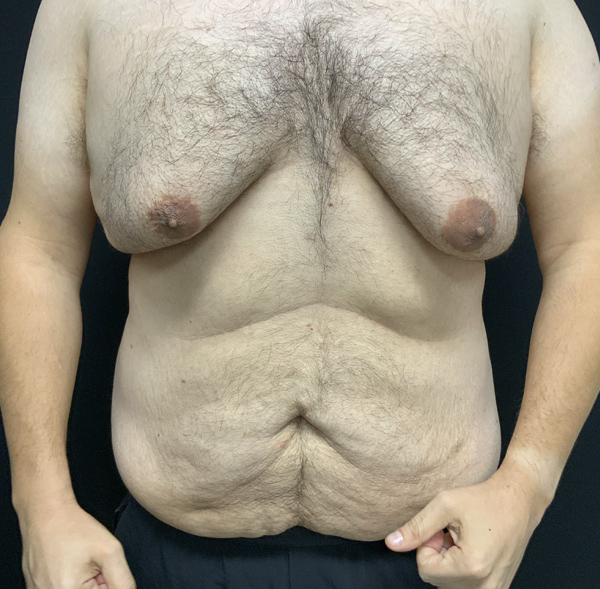 Tummy Tuck