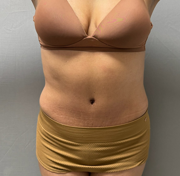 Tummy Tuck