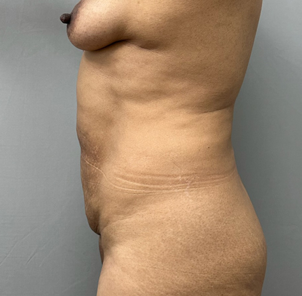 Tummy Tuck