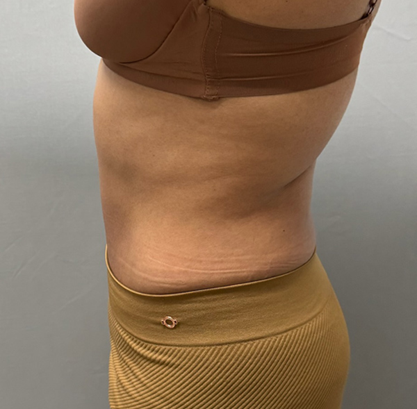 Tummy Tuck