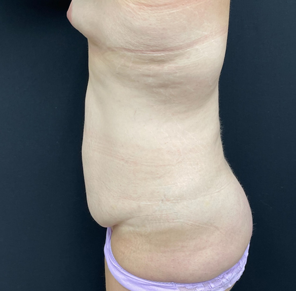 Tummy Tuck