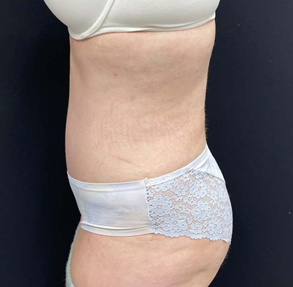 Tummy Tuck