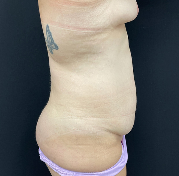 Tummy Tuck