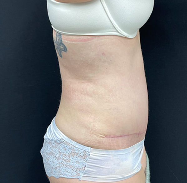 Tummy Tuck