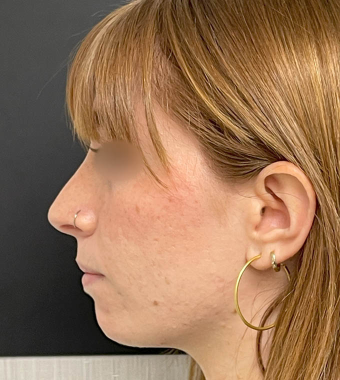Rhinoplasty