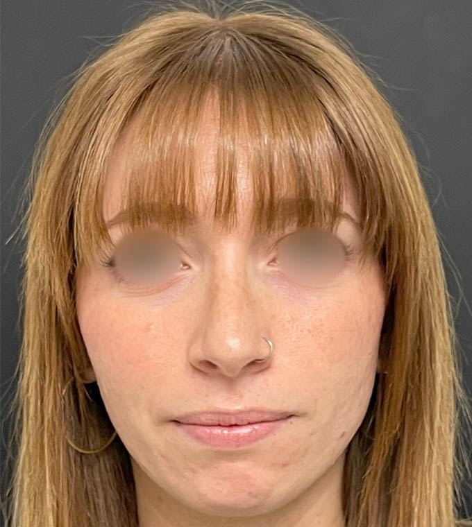 Rhinoplasty