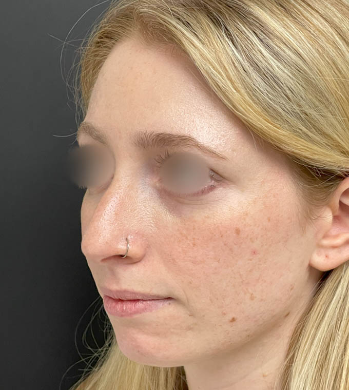 Rhinoplasty