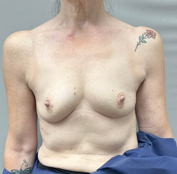 Breast Augmentation