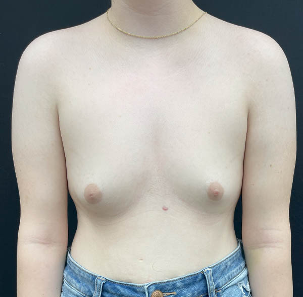 Breast Augmentation