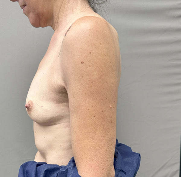 Breast Augmentation
