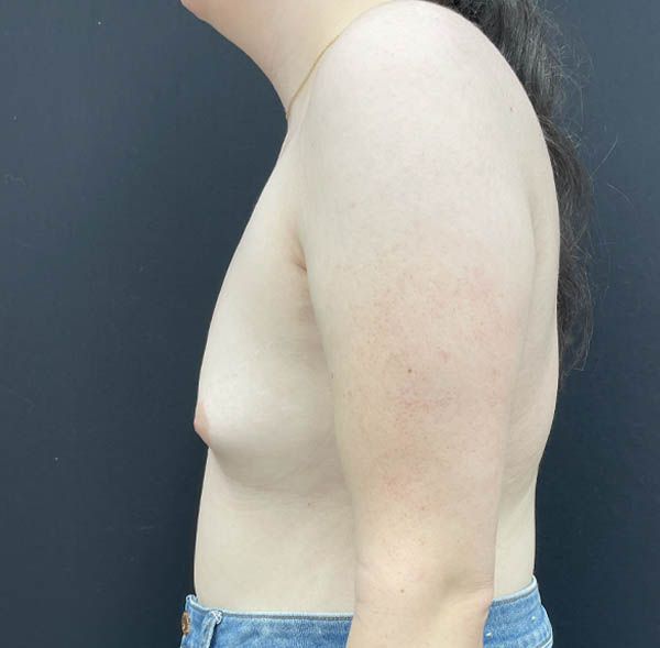Breast Augmentation