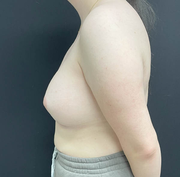 Breast Augmentation