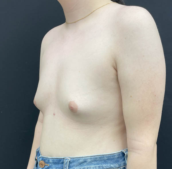 Breast Augmentation