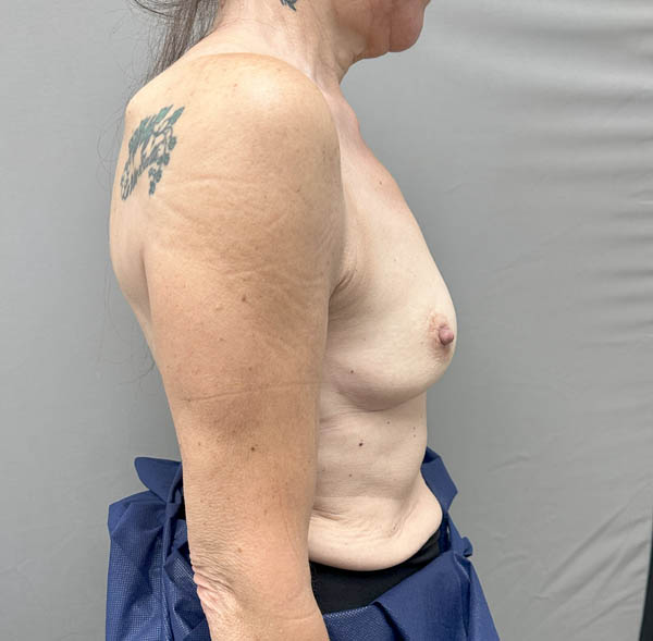 Breast Augmentation