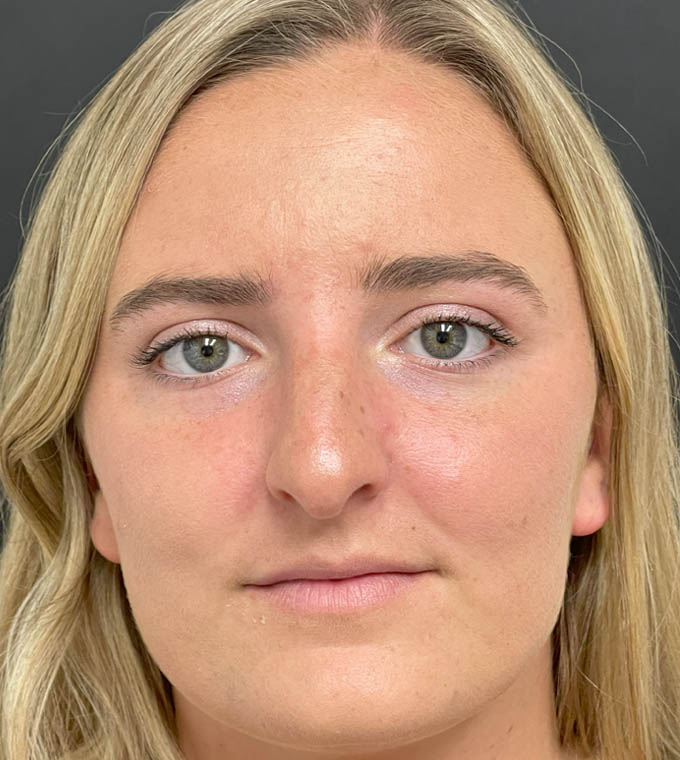 Rhinoplasty