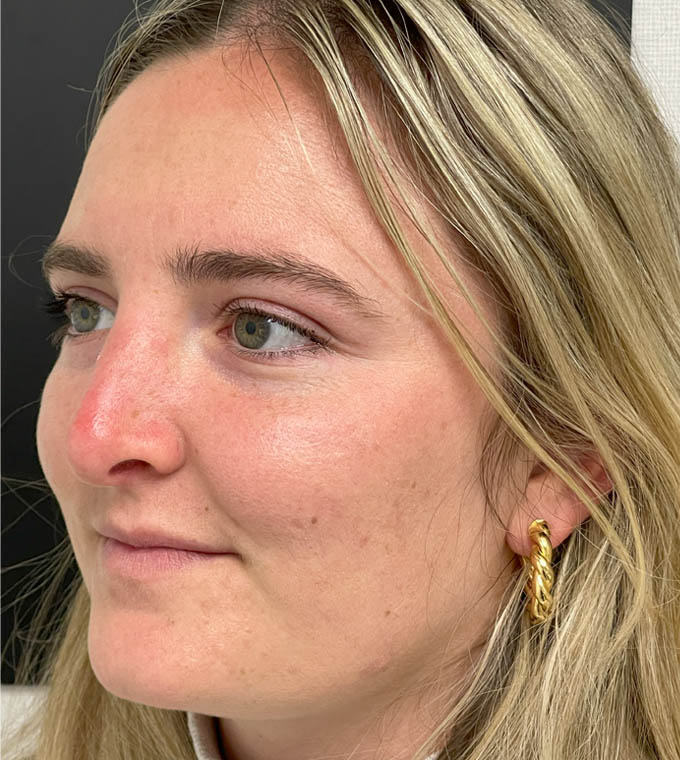 Rhinoplasty