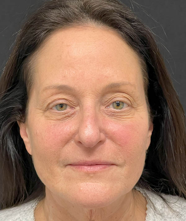 Facelift