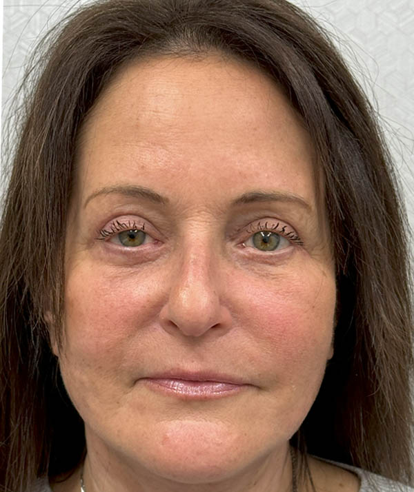 Facelift
