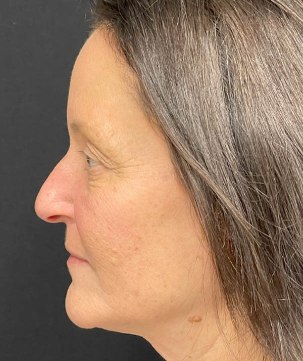 Facelift