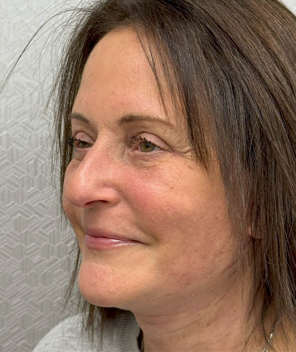 Facelift