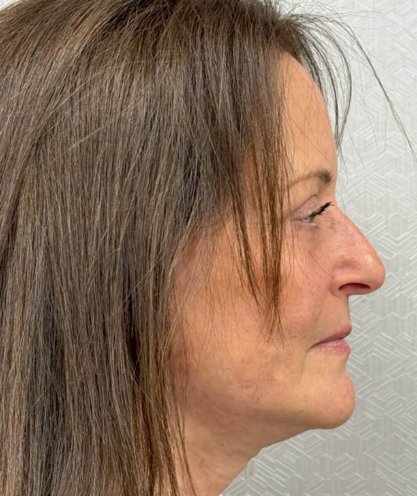 Facelift