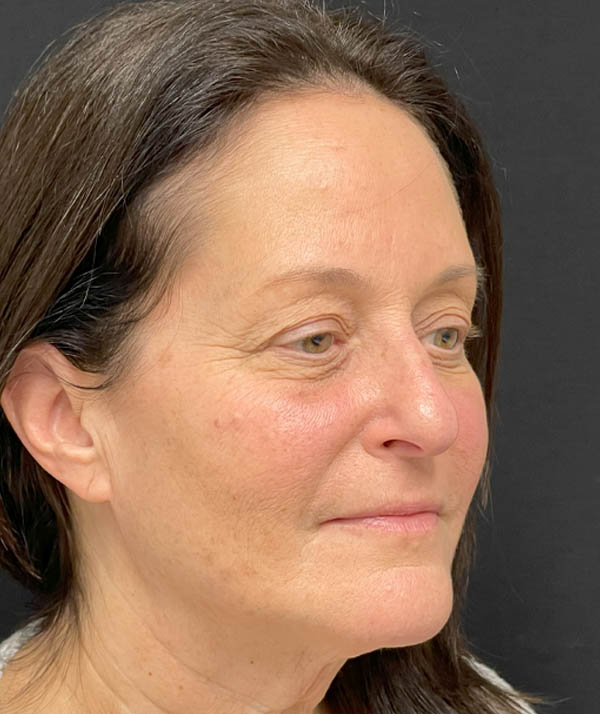 Facelift