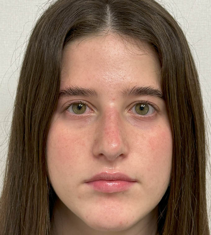 Rhinoplasty