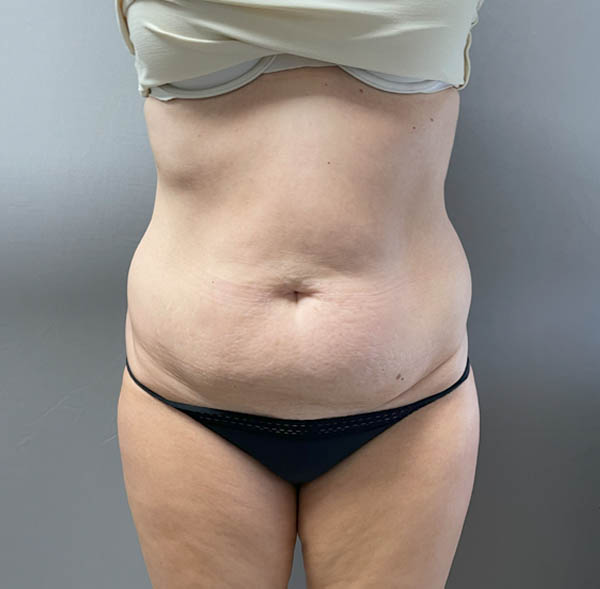 Tummy Tuck
