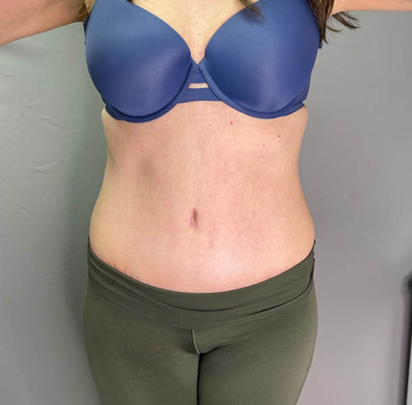 Tummy Tuck