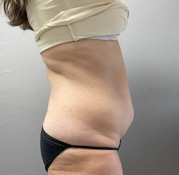 Tummy Tuck