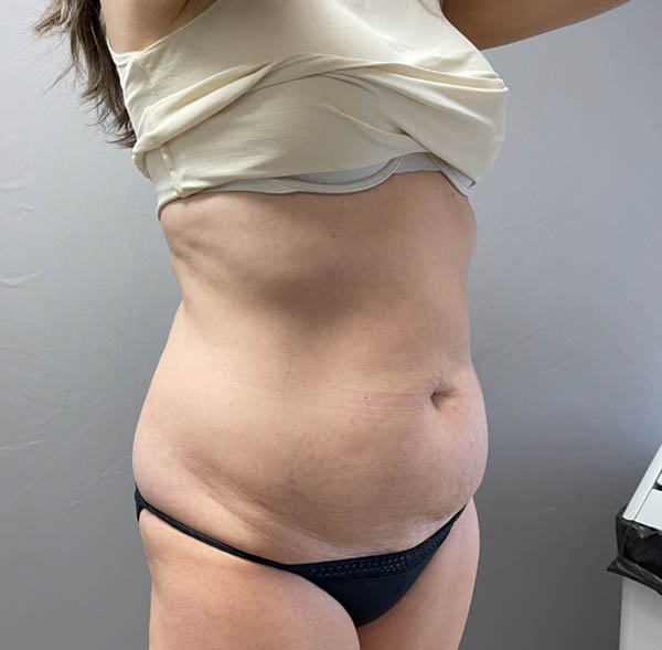 Tummy Tuck