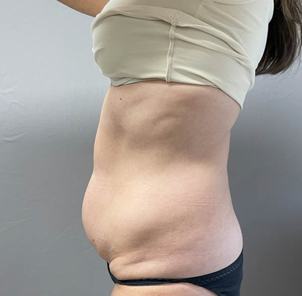 Tummy Tuck