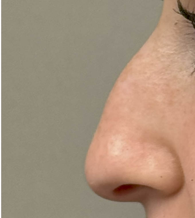 Rhinoplasty