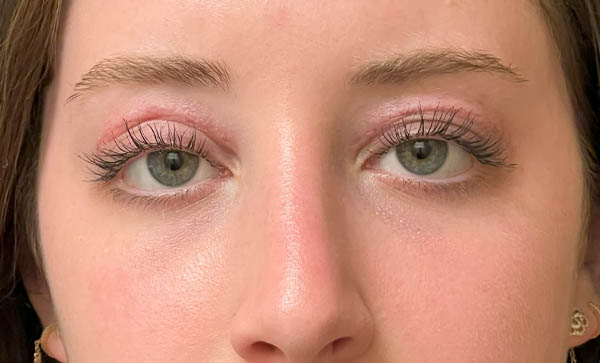 Blepharoplasty