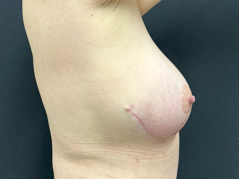 Breast Lift