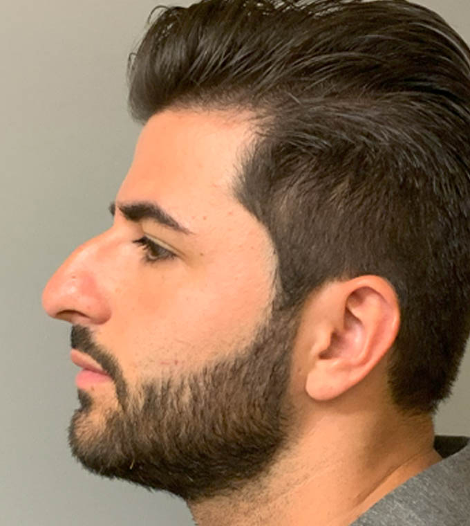 Rhinoplasty