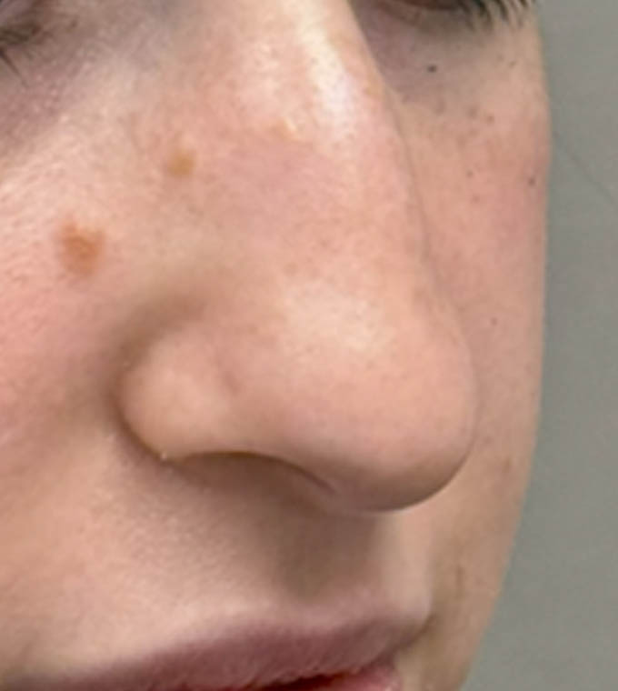 Rhinoplasty