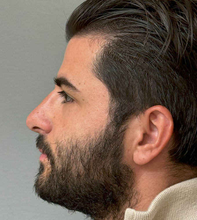 Rhinoplasty