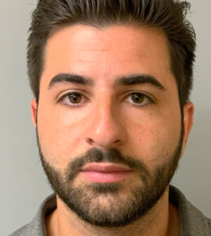 Rhinoplasty