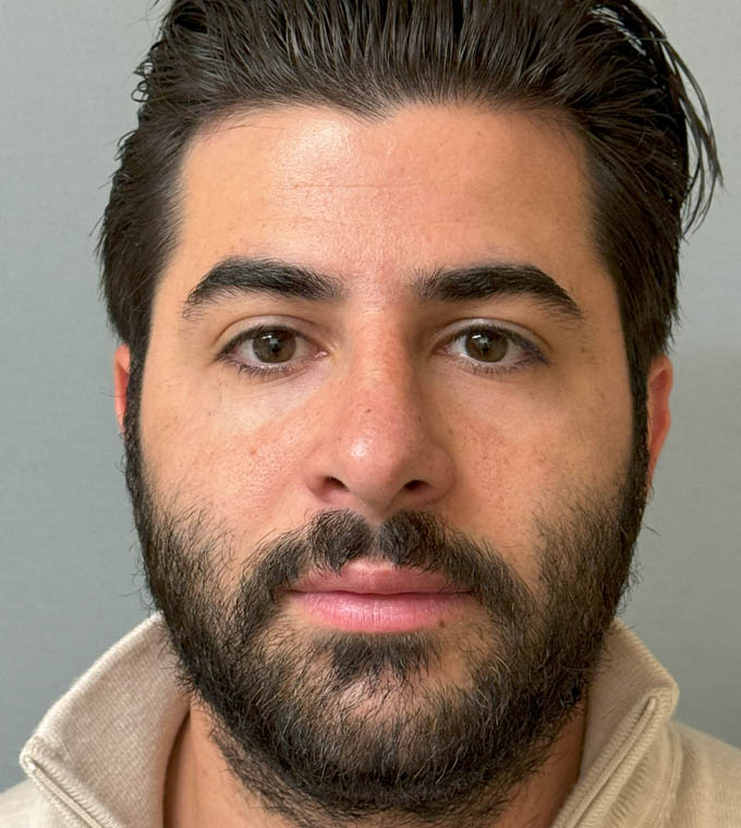 Rhinoplasty