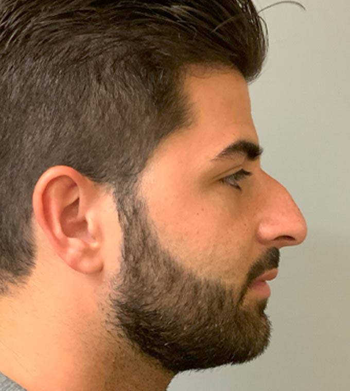 Rhinoplasty