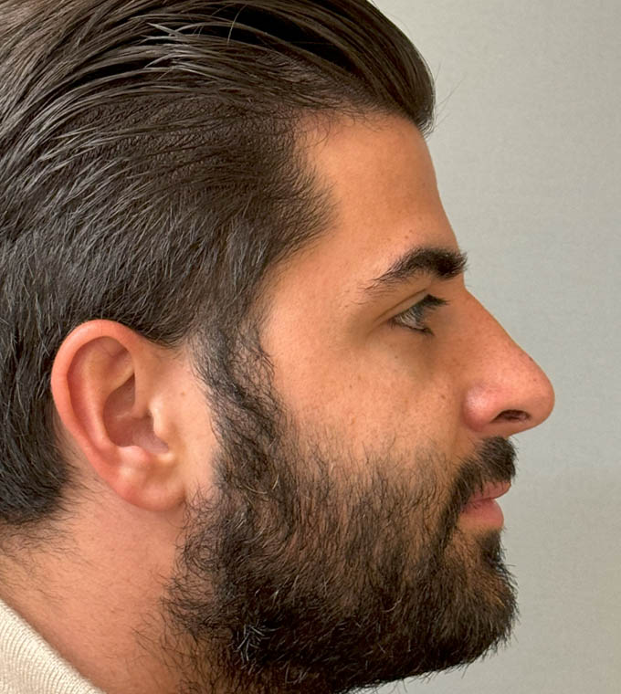Rhinoplasty