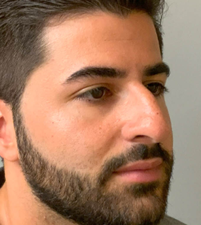Rhinoplasty